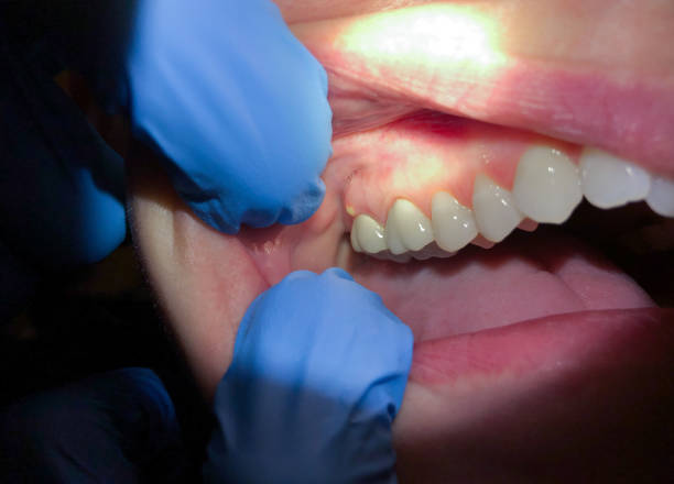 Emergency Treatment for Knocked-Out Teeth